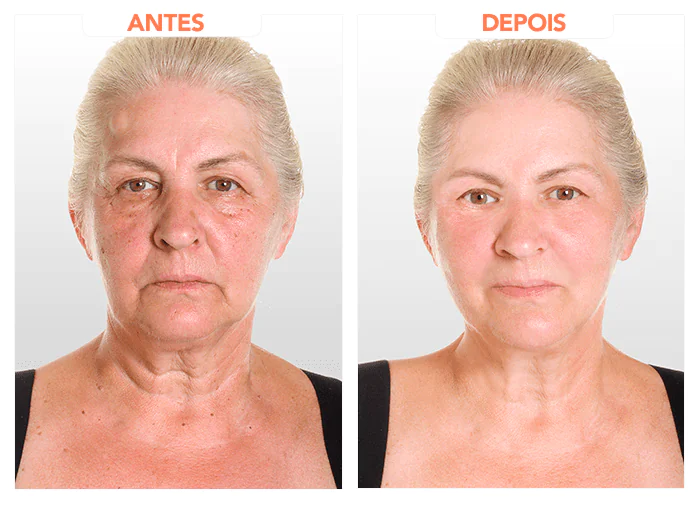 Antes e depois de uma mulher que fez o tratamento com a fórmula exclusiva americana