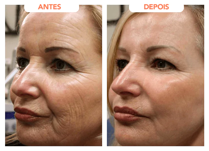 Antes e depois comprovando que Édenskin funciona mesmo