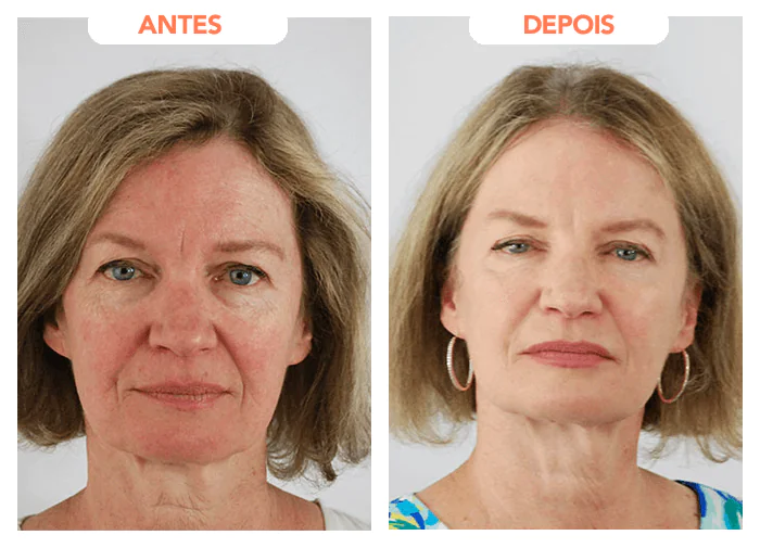 Resultados do antes e depois de um tratamento efetivo com Eden Skin