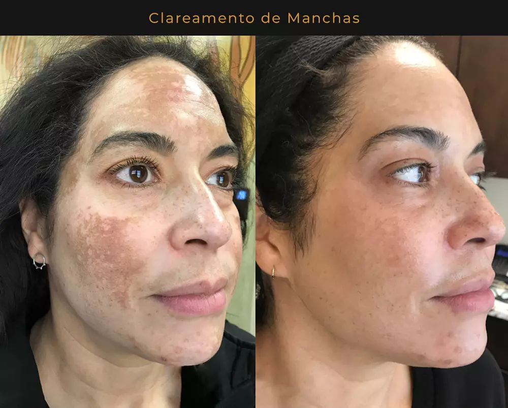 Antes e depois do tratamento com Hidra Pele mostrando clareamento de manchas