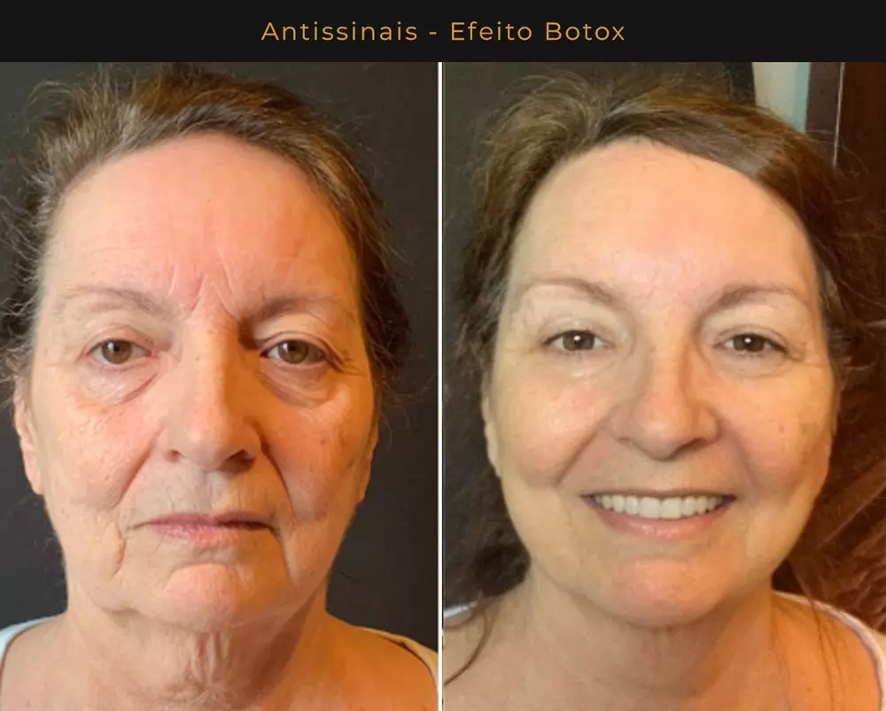 Resultados do Sérum Hidra Pele com efeito antissinais similar ao Botox